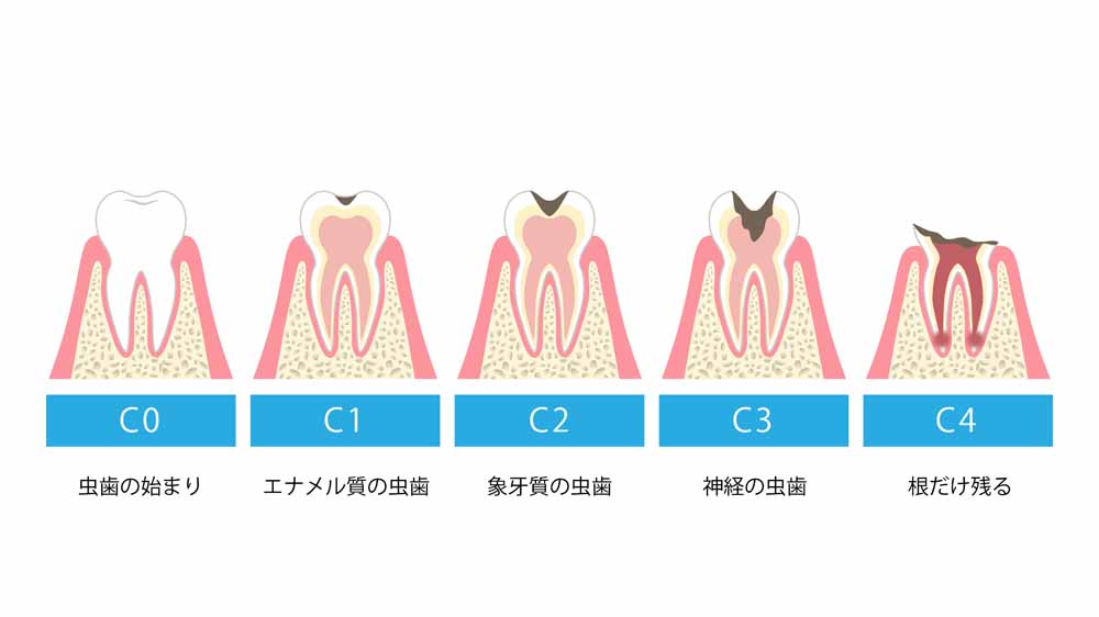 永久歯の虫歯の掘削から歯髄病変まで