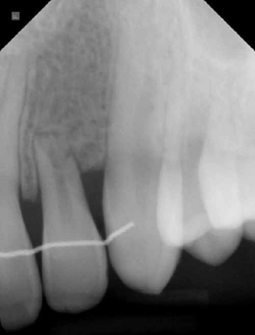 上顎の埋伏犬歯_図5