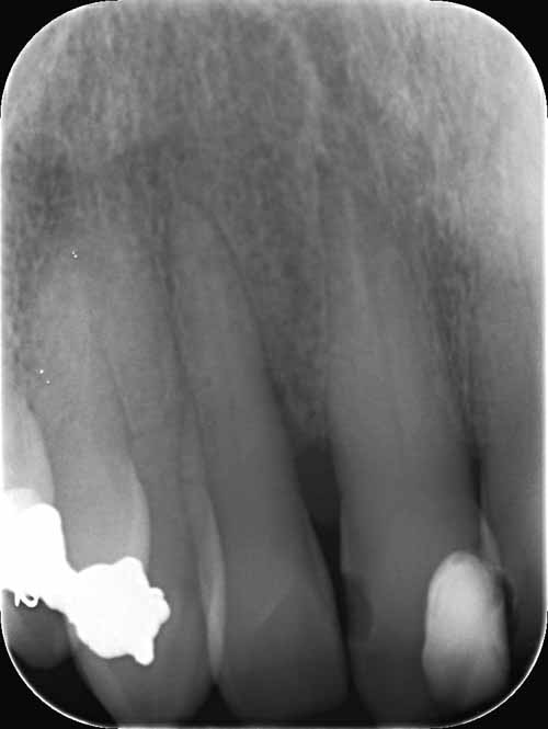 フラップ手術の補助療法としてのエナメル質マトリックスタンパク質_図4