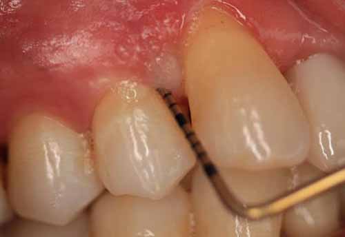 歯の周囲の骨の角度異常 – 診断と治療_図1b