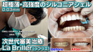 世界最強の歯科材料「ラブリエ La Briller」超極薄・高強度ジルコニア